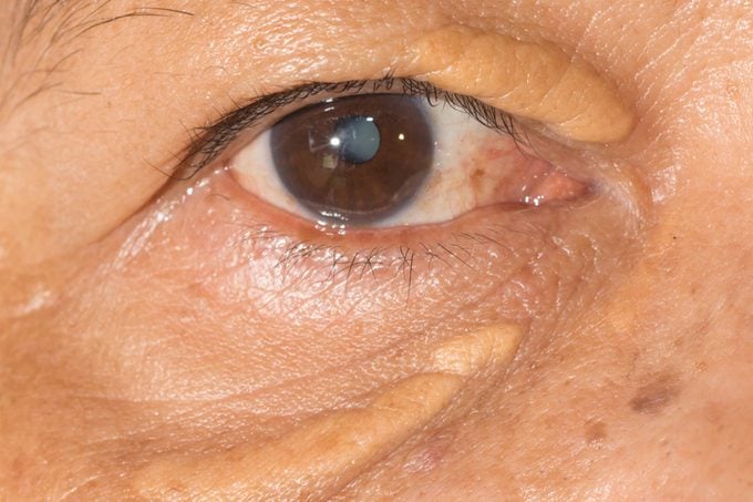 close up of an eye with xanthelasma