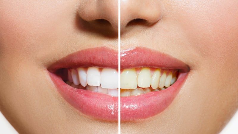 Teeth Staining Chart