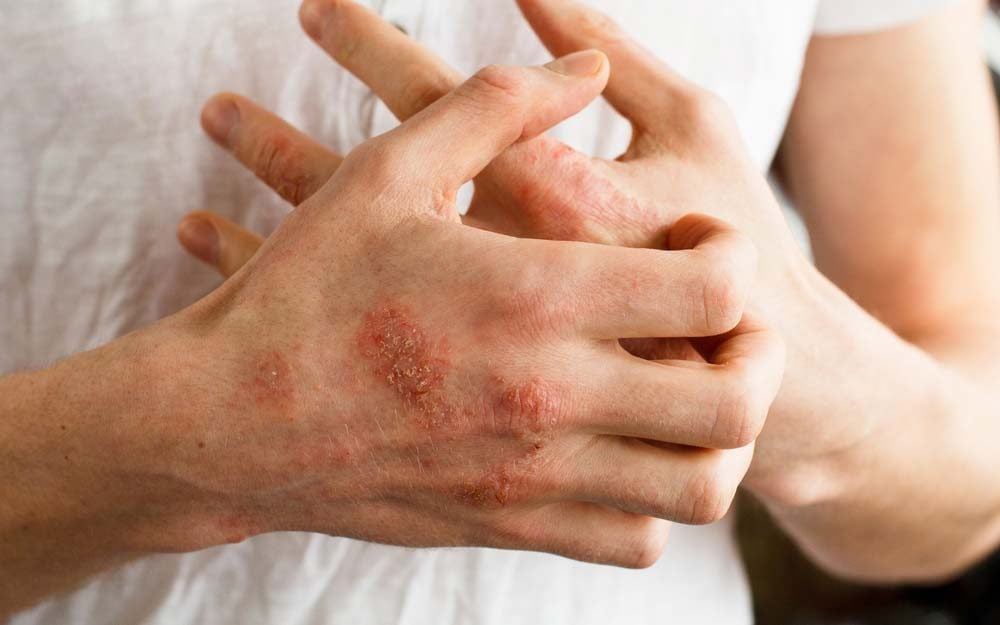 Poison Ivy Home Remedies 10 Rash Relief Treatments The