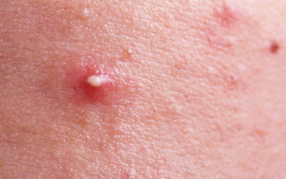 helt bestemt Modernisere Hvis Never Pop a Pimple in the Danger Triangle | The Healthy