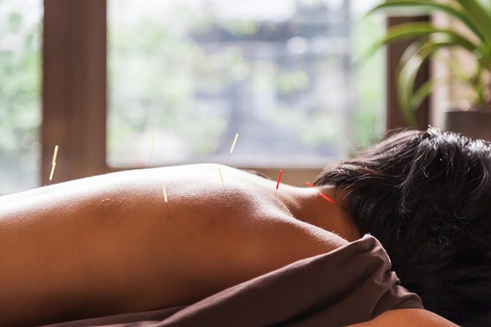 Woman with acupuncture needles in her back.