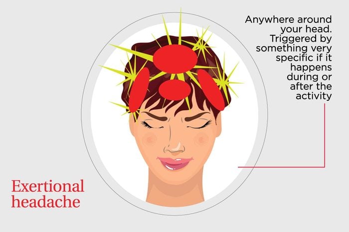 illustration of an exertional headache