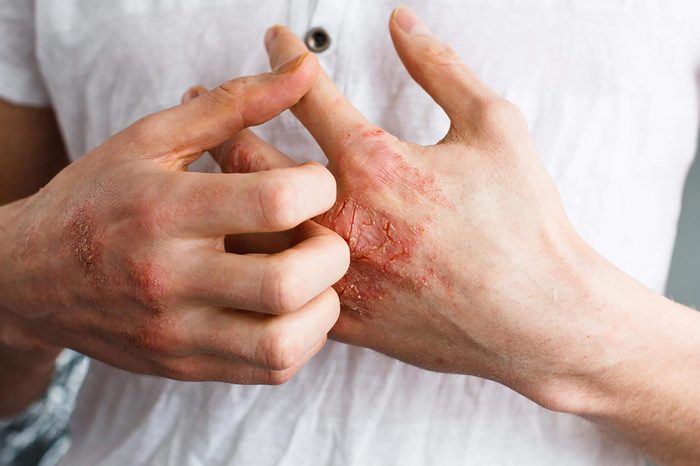 A man with a skin rash scratching his hand. 