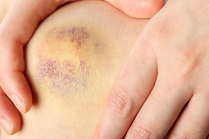 bruise on knee