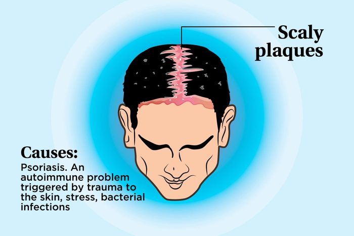 illustration of a person's scalp indicating scaly plaques
