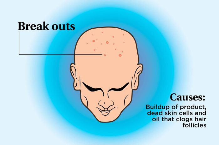 illustration of a person's scalp indicating breakouts and causes