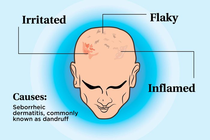 illustration of a person's scalp indicating irritation, flakes, inflammation