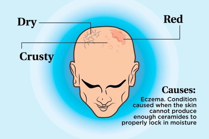 illustration of a person's scalp indicating dry, red, and crusty areas