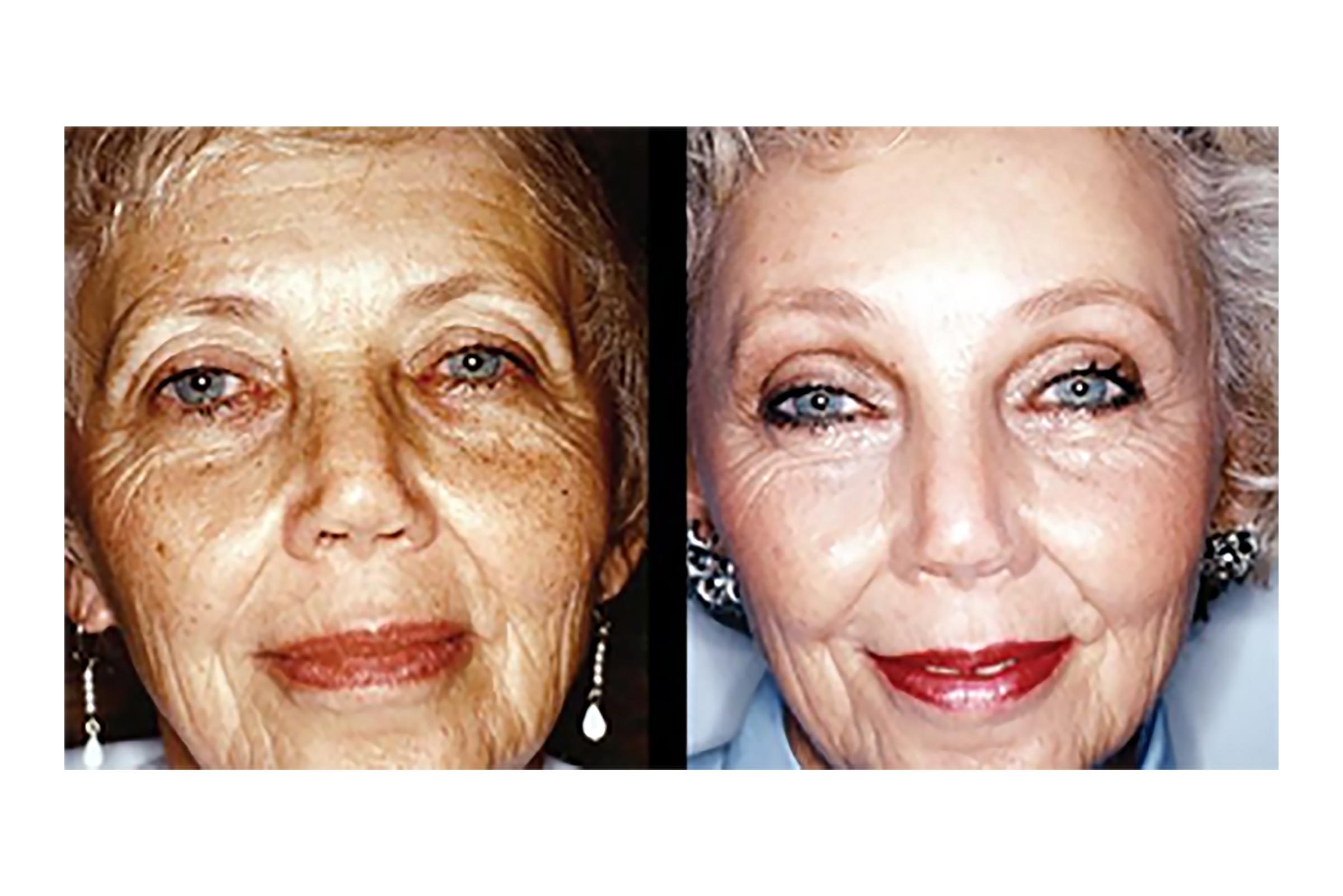 Orange County Facial Rejuvenation Surgery