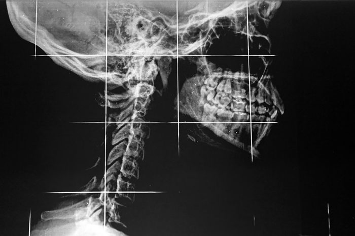 side x-ray of jaw and neck