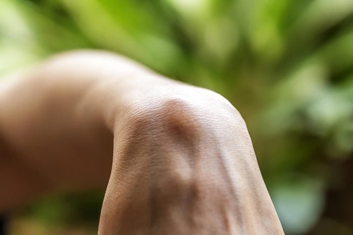 an wrist bent at a 90-degree angle with a bump revealing a ganglion cyst