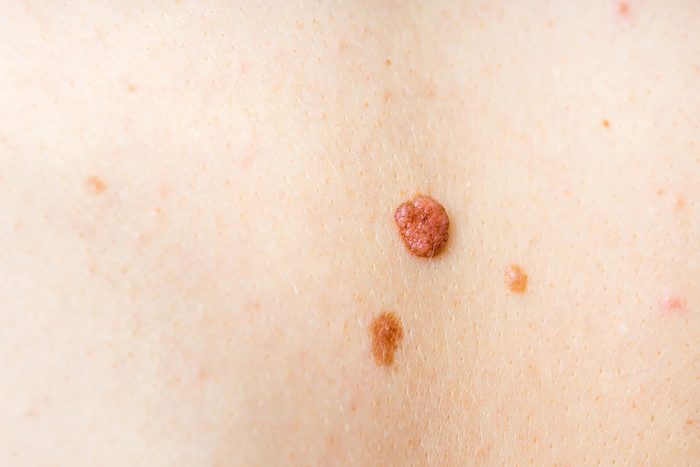 Two skin tags on a person's skin.