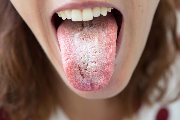 woman sticking out her tongue with thrush