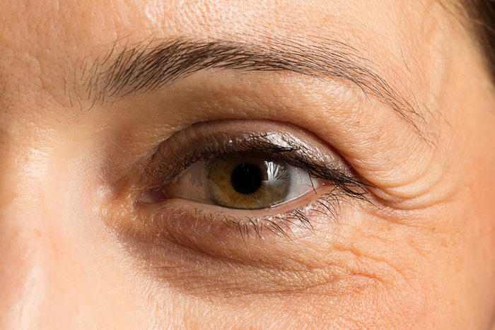 Closeup of a woman's under-eye dark circle. 