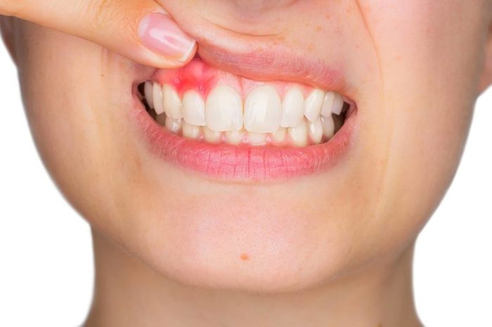 closeup of woman's gums