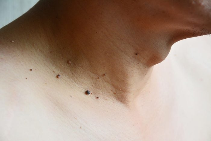 Person's neck with skin tags.