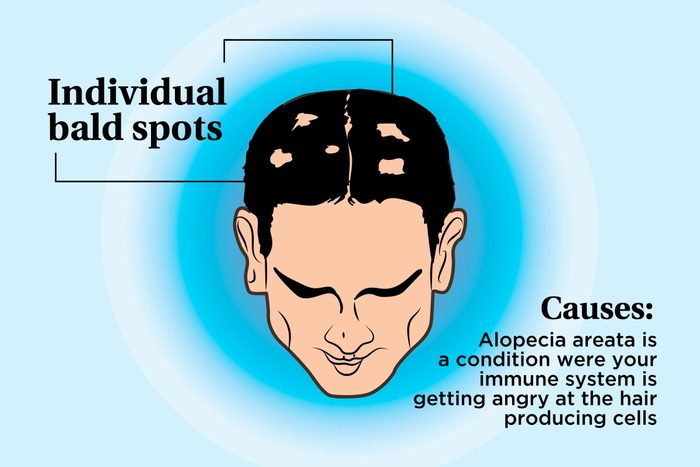 illustration of a person's scalp indicating bald spots