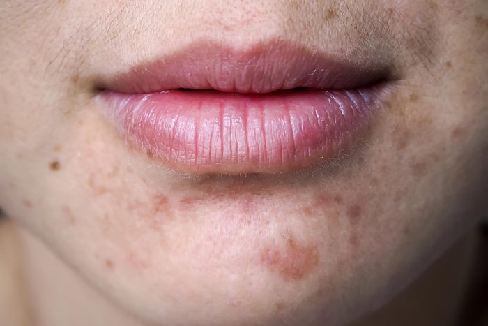 Close-up of acne scars.