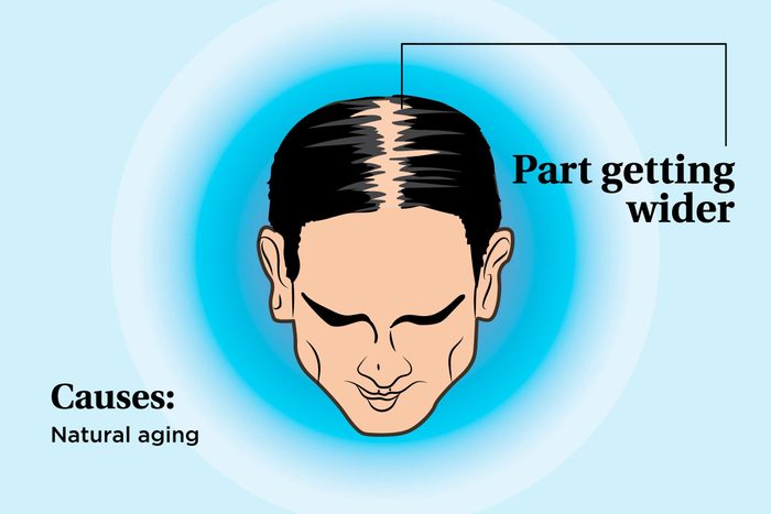 illustration of a person's scalp indicating the part widening
