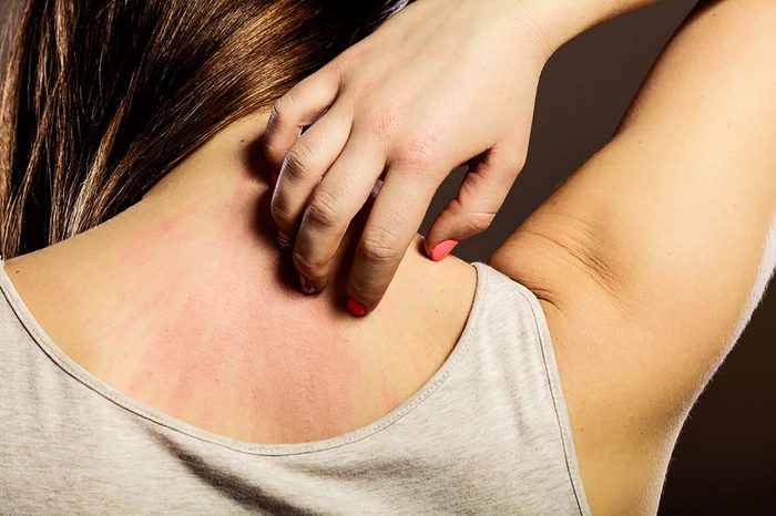 woman itching itching red patches on her upper back