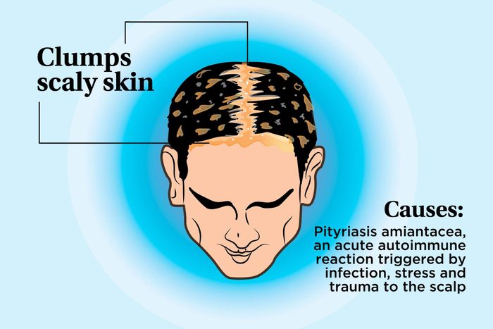 illustration of a person's scalp indicating clumps of scaly skin