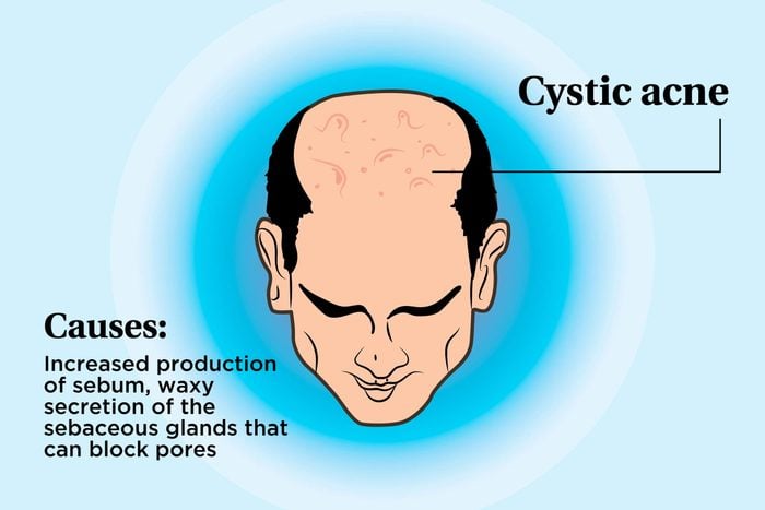 illustration of a person's scalp indicating cystic acne