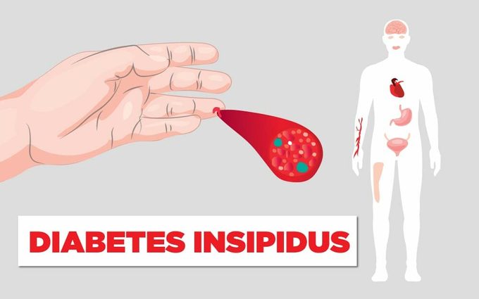 Things-You-Need-to-Know-About-Diabetes-Insipidus