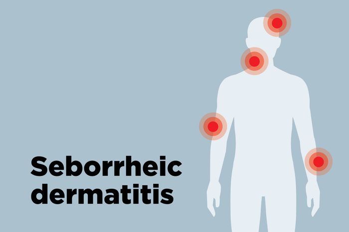 outline of body showing dermatitis hotspots
