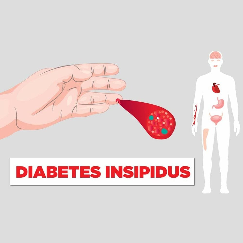 Insipidus diabetes What is