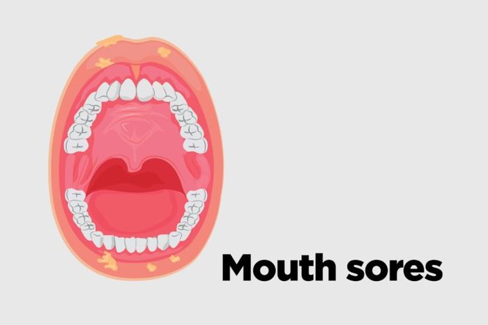 Illustration of an open mouth with mouth sores.