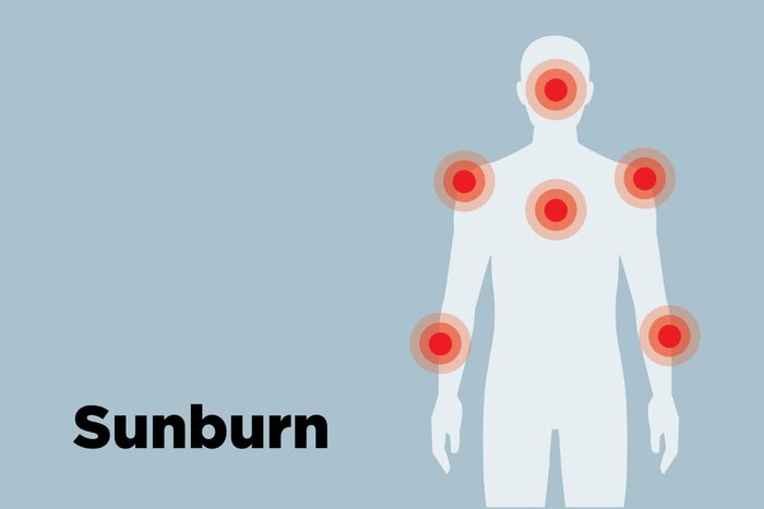 outline of body showing sunburn hot spots