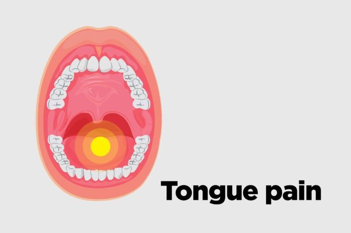 Illustration of an open mouth with tongue pain.