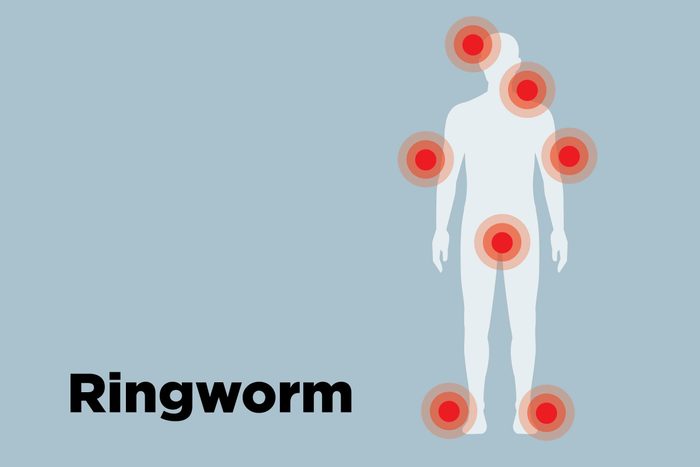 outline of body showing ringworm hotspots