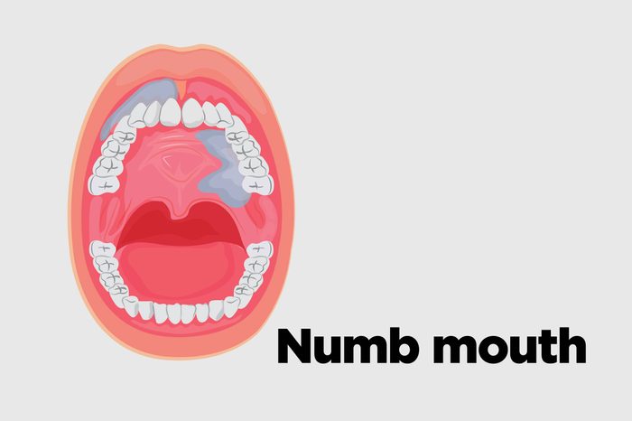 Illustration of an open mouth with numbness in the mouth.