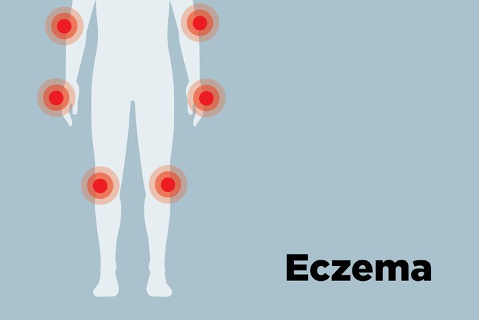 outline of body showing eczema hotspots