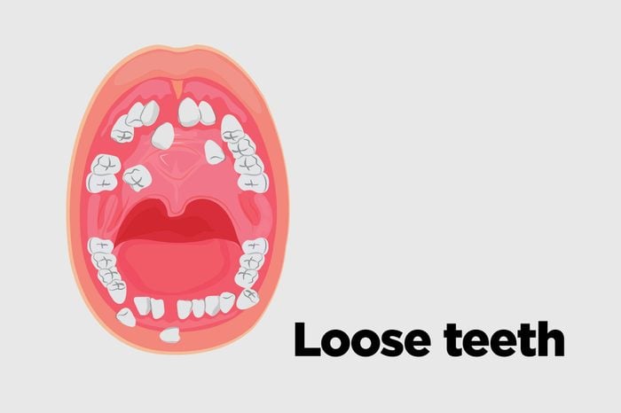 Illustration of an open mouth with lose teeth.
