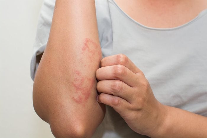 patient scracthing allergic rash dermatitis skin on elbow