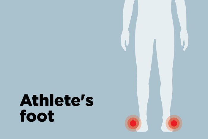 outline of body showing athlete's foot hotspots