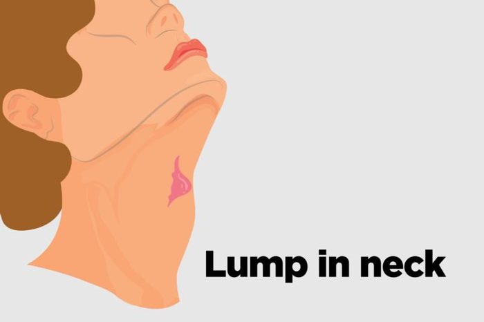 Illustration of a person's neck with a lump in it.