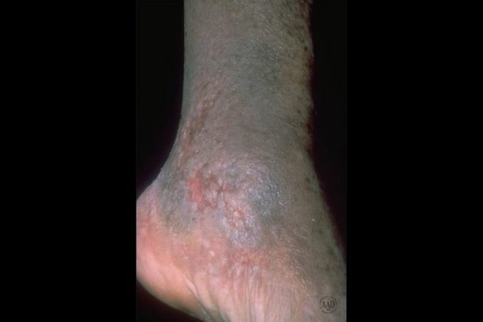 close-up of foot with stasis dermatitis