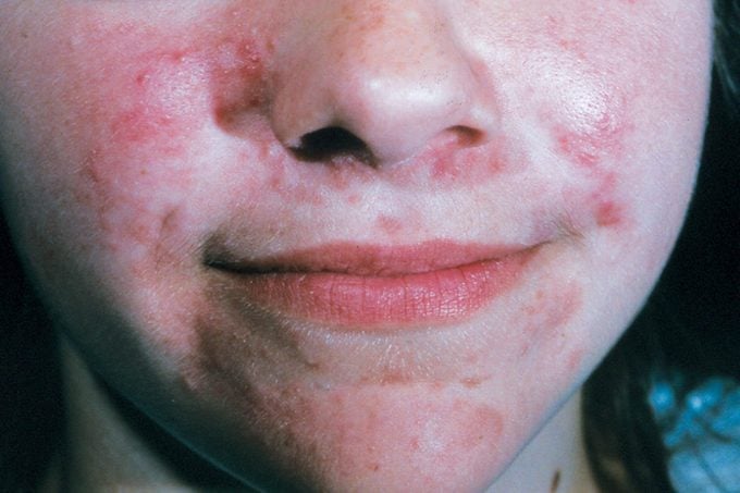 A case of perioral dermatitis.