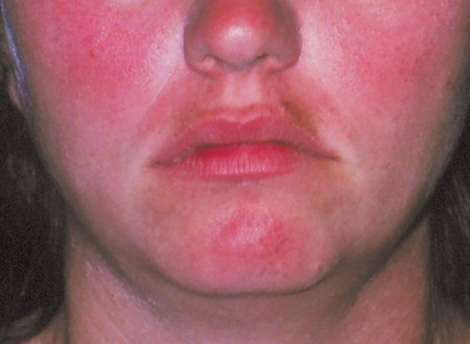 woman's face with rosacea