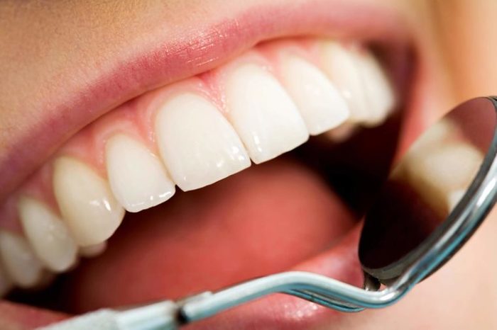 person smiling as dentist checks teeth with dental mirror