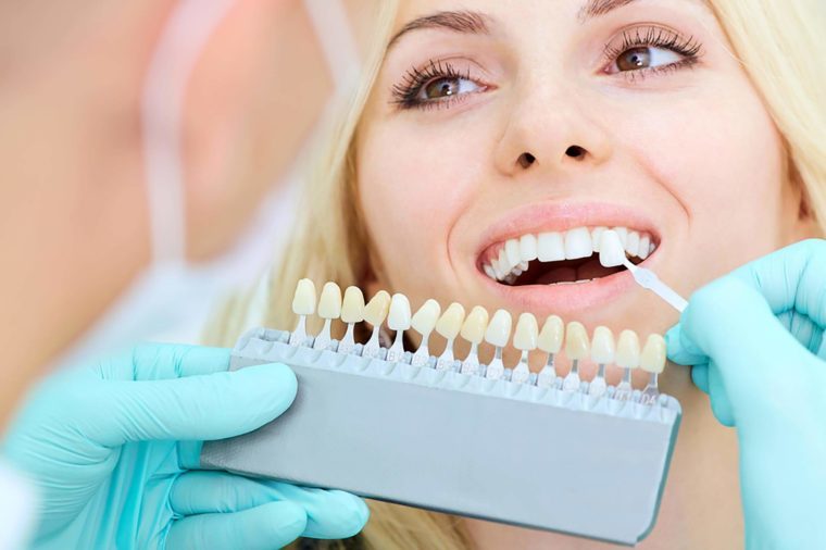 woman trying on veneers for her teeth