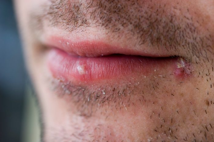 man with cold sore on mouth