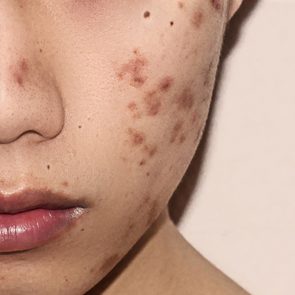 woman asian acne closeup skin face