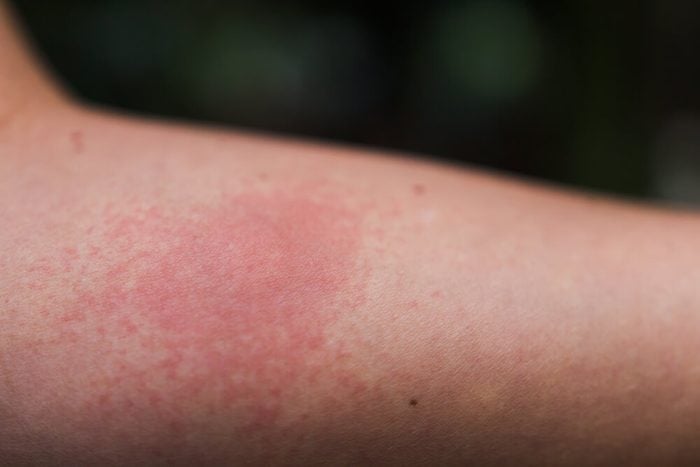 red swollen skin from mosquito bites
