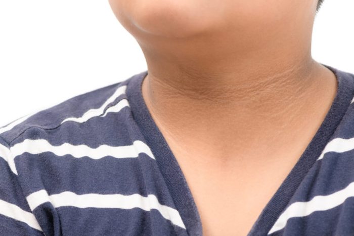 acanthosis nigricans insulin resistance