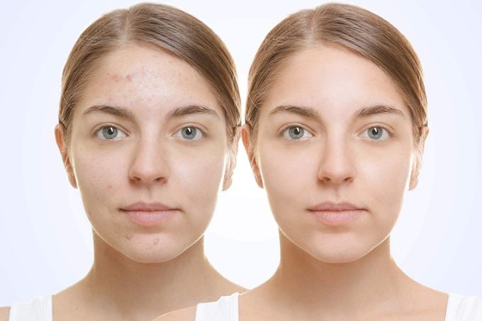 Two pictures of same young woman with and without acne