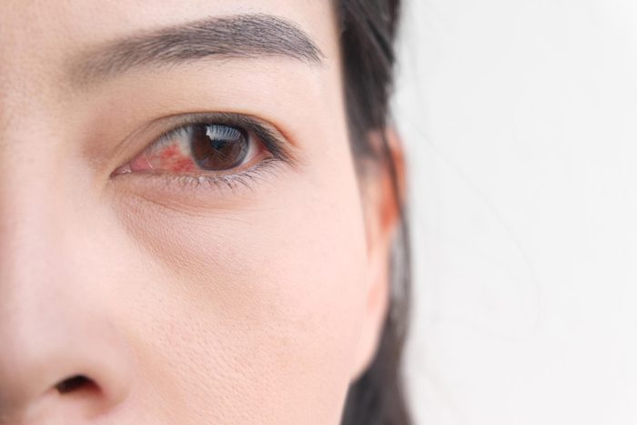 woman conjunctivitis pink eye